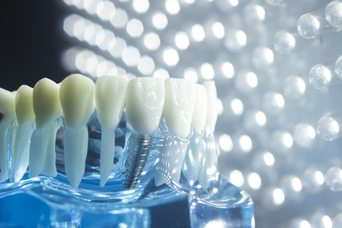 Dentists dental teeth teaching model showing each tooth, gum, root, implant, decay, plaque and enamel.