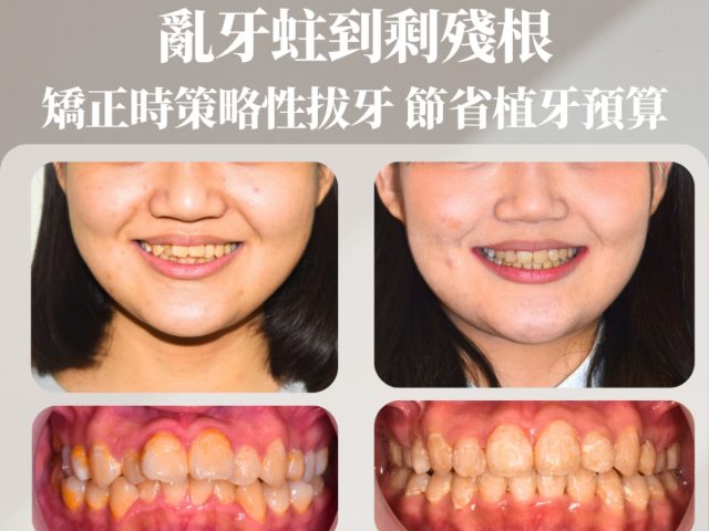 亂牙蛀到剩殘根：矯正時策略性拔牙，節省植牙預算