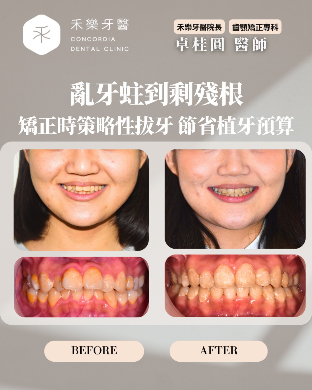 亂牙蛀到剩殘根