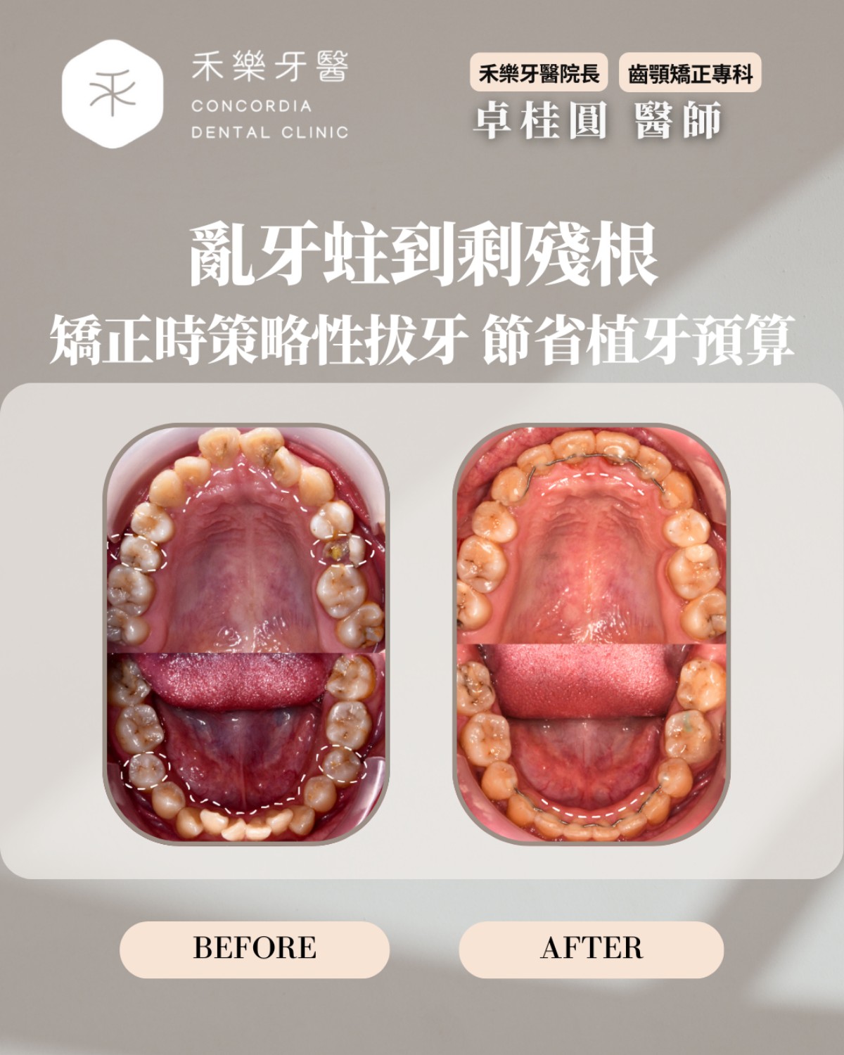 亂牙蛀到剩殘根