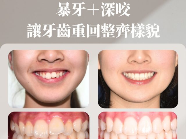 改善前牙單顆錯咬＋深咬 展露笑顏 氣質更出眾