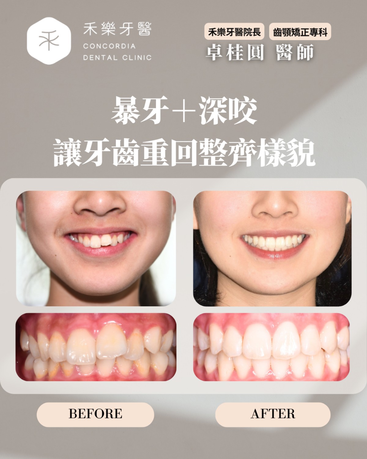 暴牙消失了 微妙改變氣質更出眾