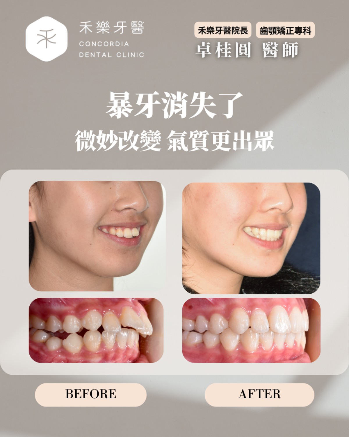 暴牙消失了 微妙改變氣質更出眾