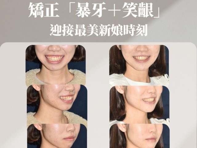 矯正暴牙＋笑齦  迎接最美新娘時刻