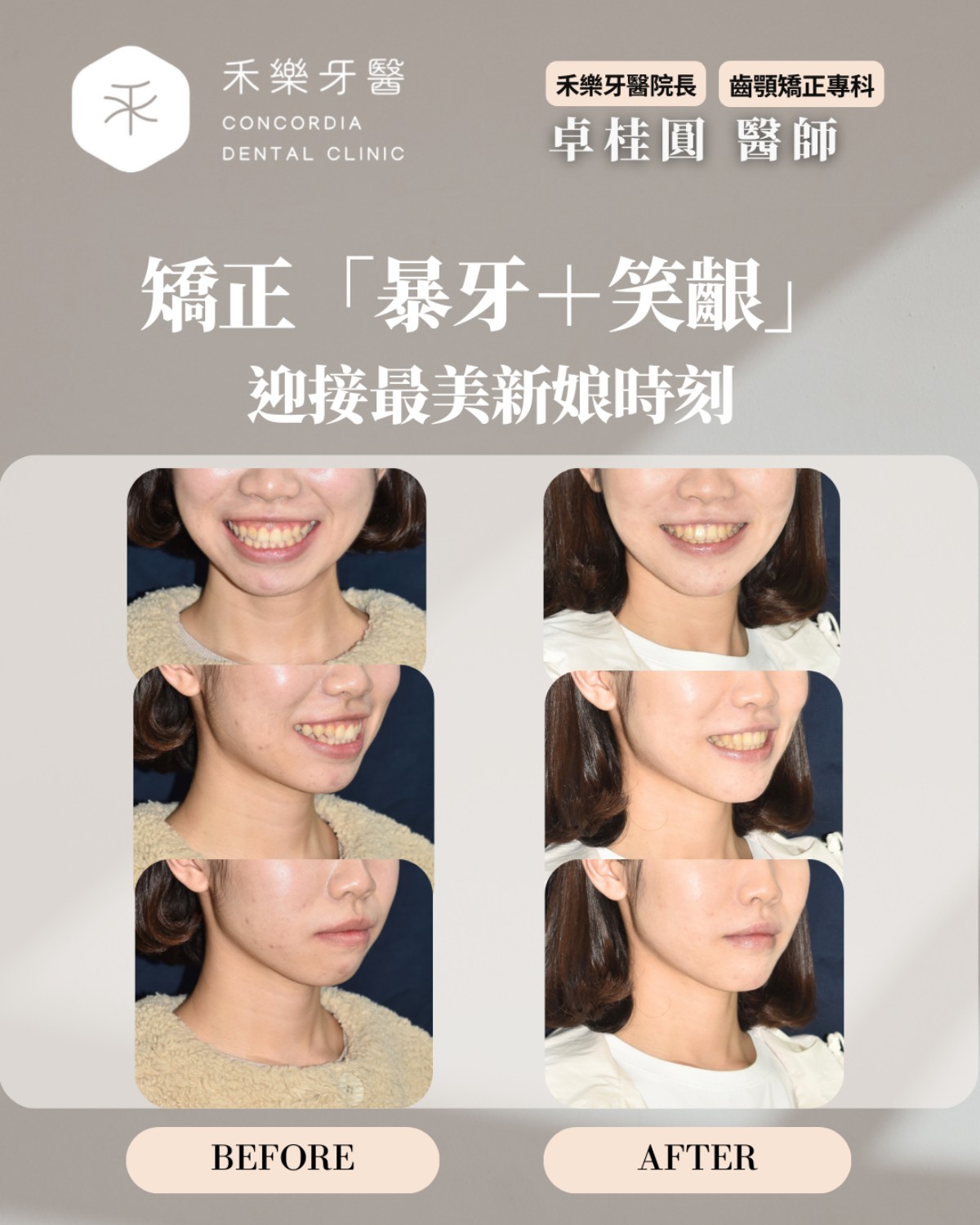 矯正暴牙＋笑齦 迎接最美新娘時刻