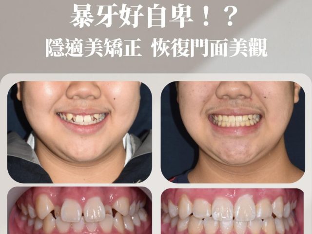 暴牙好自卑！？隱適美矯正 恢復門面美觀