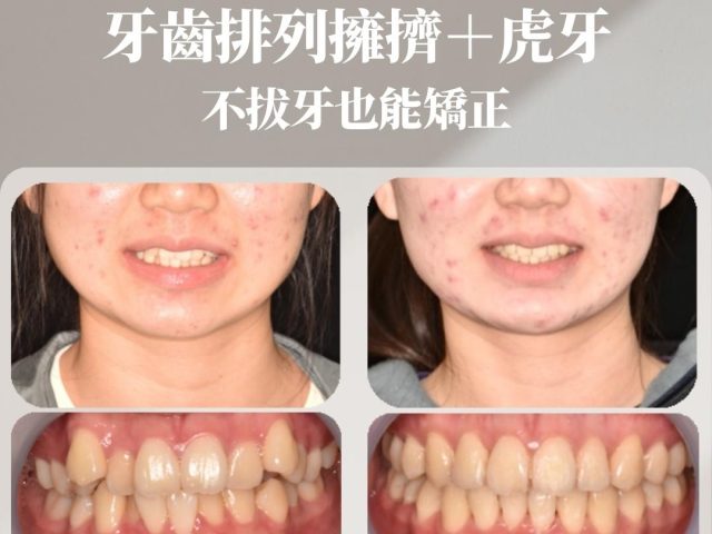 牙齒排列擁擠＋虎牙，不拔牙也能矯正