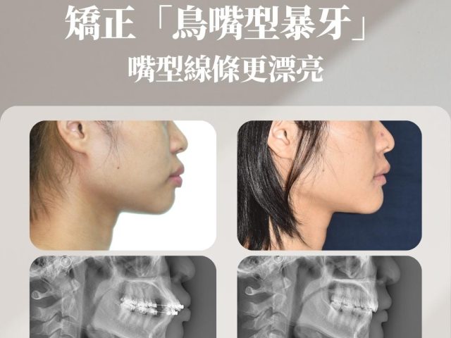 恢矯正「鳥嘴型暴牙」嘴形線條更漂亮