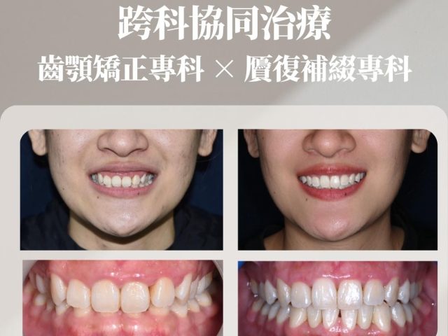 恢復理想咬合 微笑曲線更好看