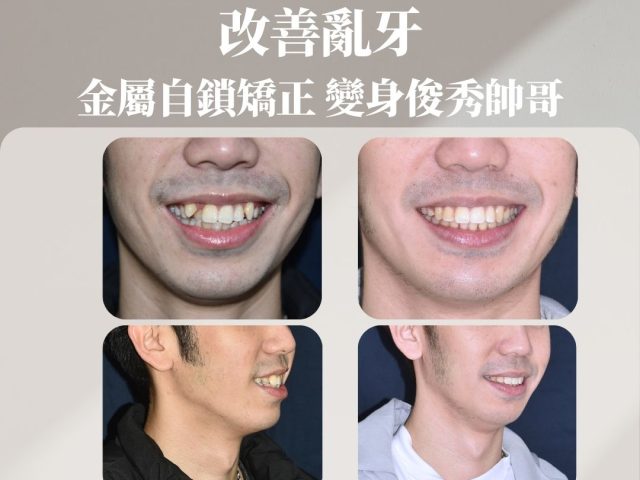 亂牙嘴凸 臉型不好看 矯正變身俊秀型男