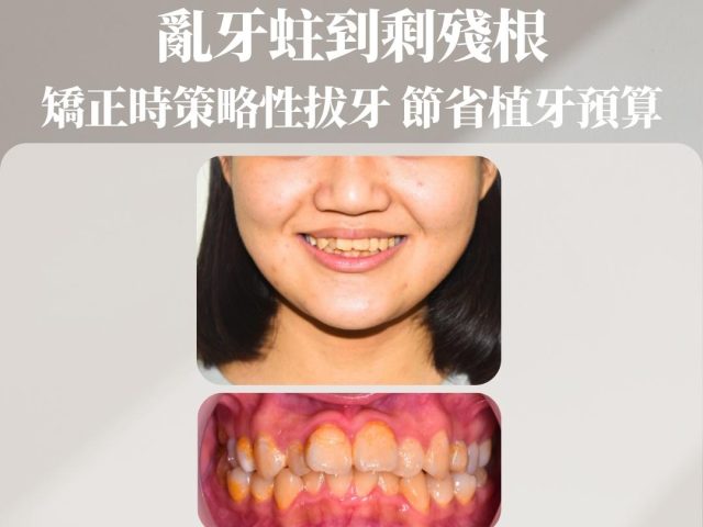 亂牙蛀到剩殘根，矯正時策略性拔牙，節省植牙預算