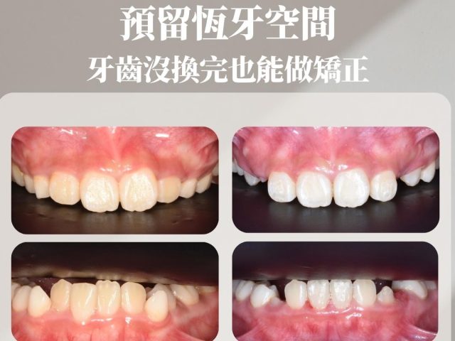 掌握預防性矯正黃金期，牙齒沒換完也能做矯正