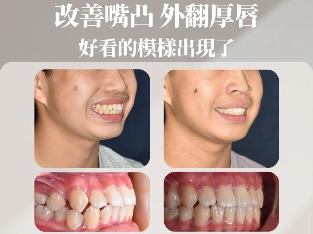 改善嘴凸、外翻厚唇 好看的模樣出現了