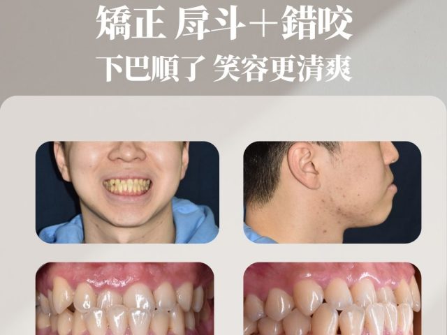 改善戽斗＋錯咬 下巴順了 笑容更清爽