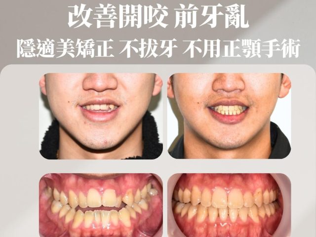 改善開咬 前牙亂 隱適美矯正 不拔牙 不用正顎手術