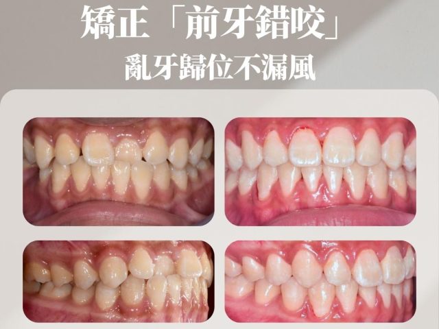 矯正「前牙單顆錯咬」 亂牙歸位不漏風，礙眼牙縫也消失了