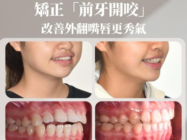 矯正「前牙開咬」，改善外翻嘴唇更秀氣