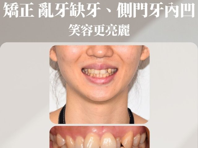 矯正亂牙缺牙、側門牙內凹，笑容更亮麗