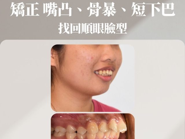 矯正嘴凸、骨暴、短下巴，找回順眼臉型
