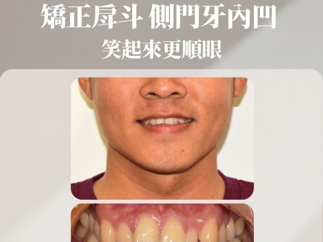 矯正戽斗 側門牙內凹 笑起來更順眼